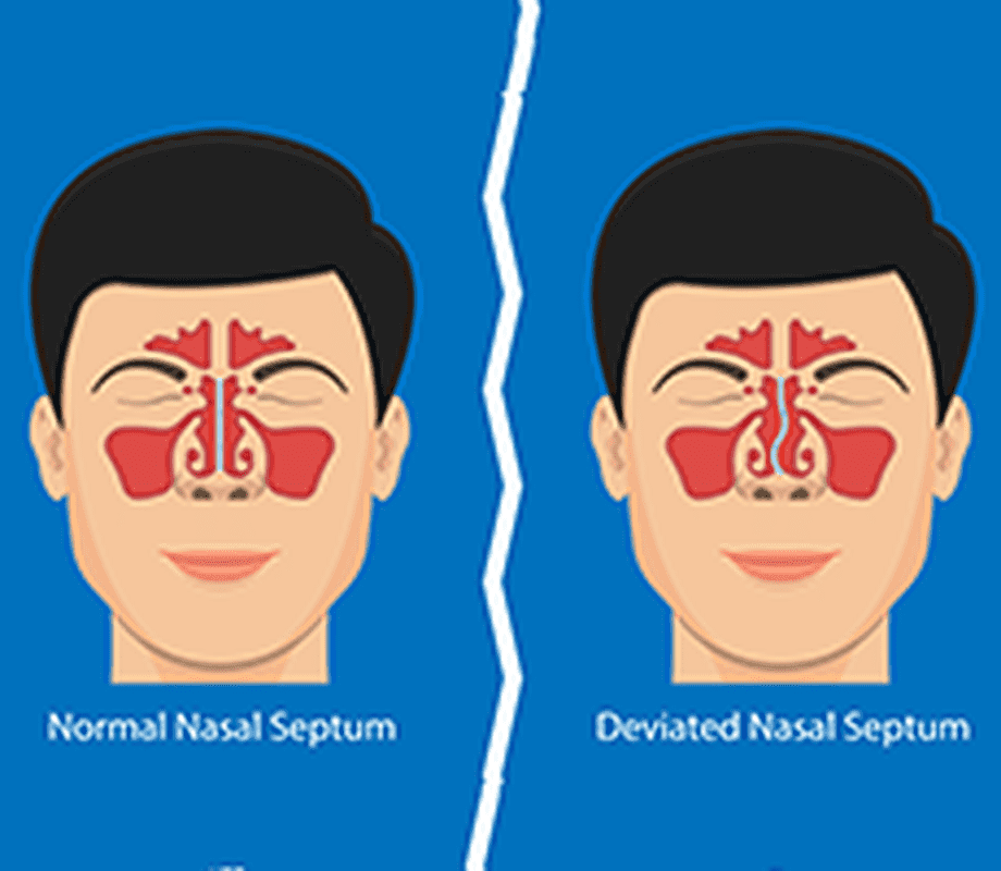Deviated Septum — treatment at Dr. Shawl's office