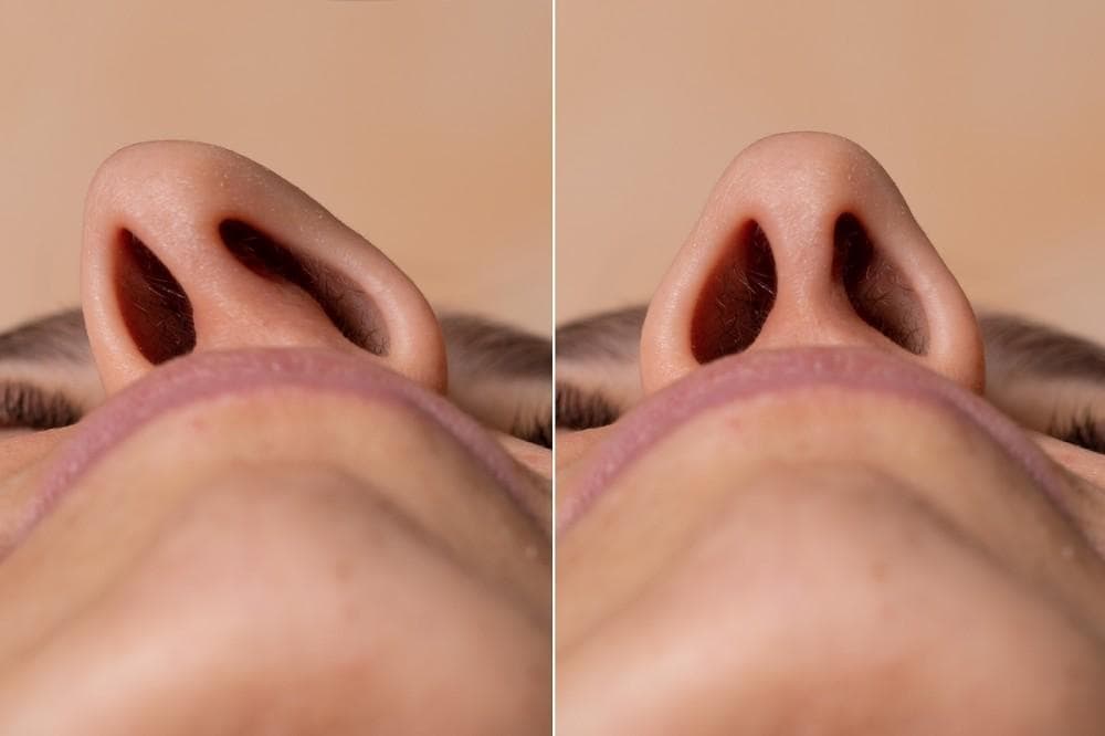 Does the Correction of a Deviated Septum Require Surgery?